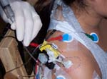 2_nerve_block 