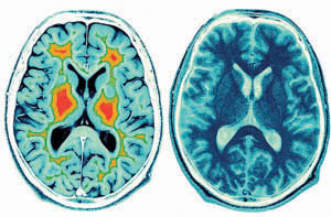Magnetic Resonance Images of the inside of the brain